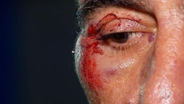 No Barro Vermelho, um homem foi agredido com uma coronhada no rosto (Foto: Reprodução/Inter TV Cabugi)
