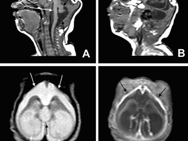 Exame de imagem revela danos cerebrais de bebês com microcefalia.