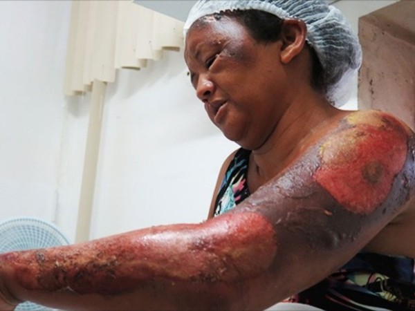 Deuzilene da Silva teve queimaduras pelo corpo em atentado em Mossoró.