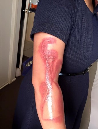 Não é tatuagem, é queimadura de segundo grau | Reprodução/Facebook(Melanie Tan Pelaez)